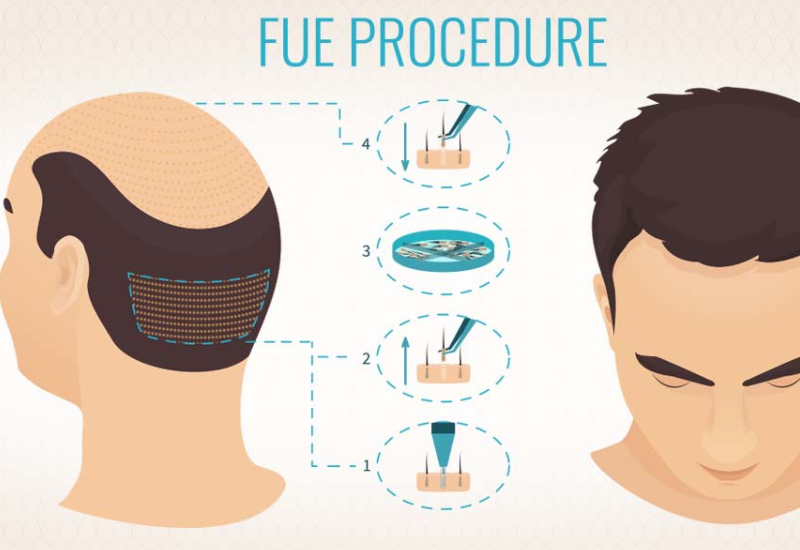 THE HAIR TRANSPLANTATION PROCESS