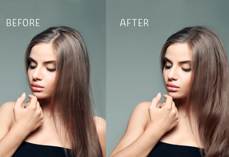 WOMEN HAIR TRANSPLANTATION